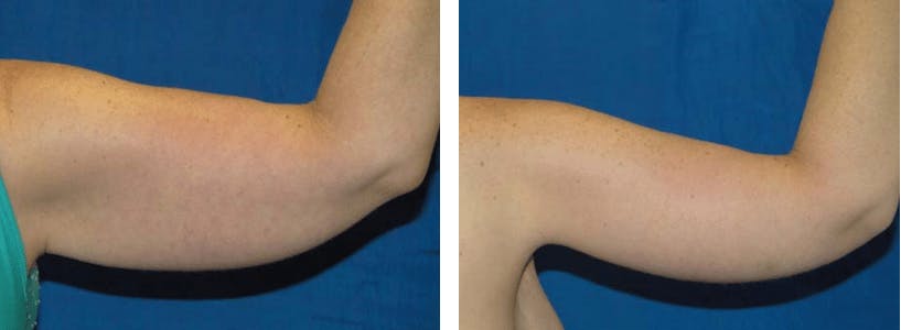 Arm Lift Before & After Gallery - Patient 74866636 - Image 1