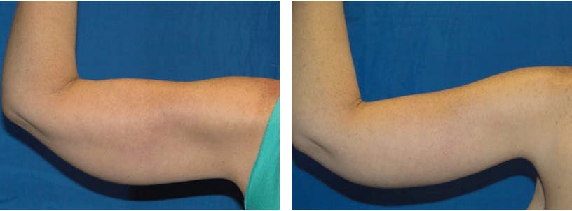 Arm Lift Before & After Gallery - Patient 74866636 - Image 2