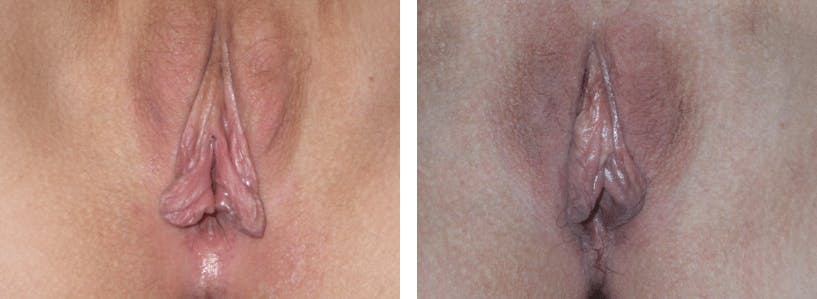 Labiaplasty Before & After Gallery - Patient 74870892 - Image 1
