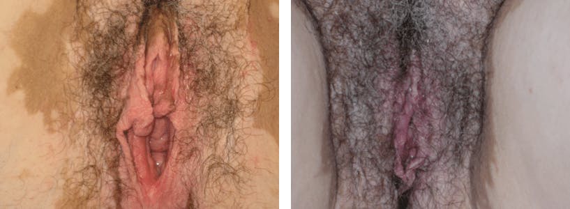 Labiaplasty Before & After Gallery - Patient 74870898 - Image 1