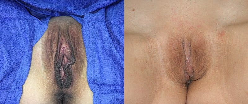 Labiaplasty Before & After Gallery - Patient 74870899 - Image 1