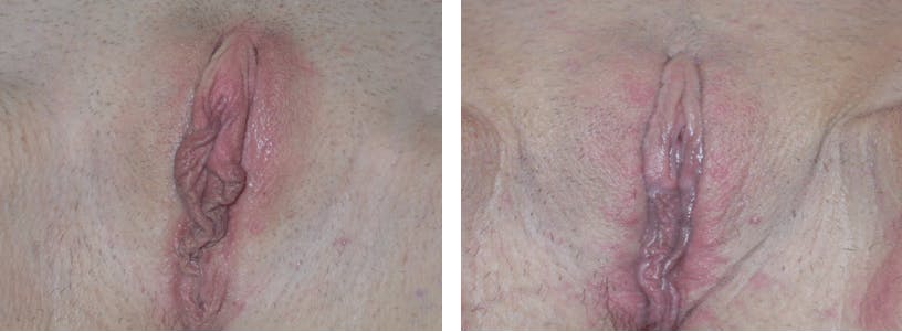 Before And After Labiaplasty