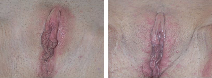 Labiaplasty Before & After Gallery - Patient 74870891 - Image 1