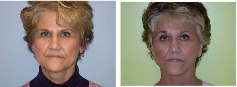 Facelift Before & After Gallery - Patient 74871010 - Image 1