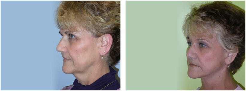 Facelift Before & After Gallery - Patient 74871010 - Image 2