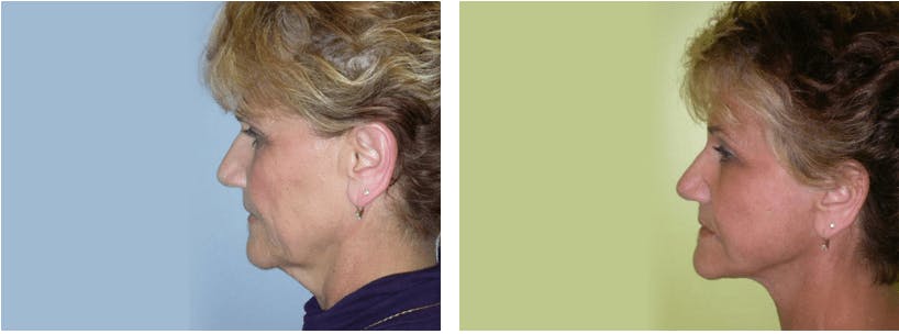 Facelift Before & After Gallery - Patient 74871010 - Image 3