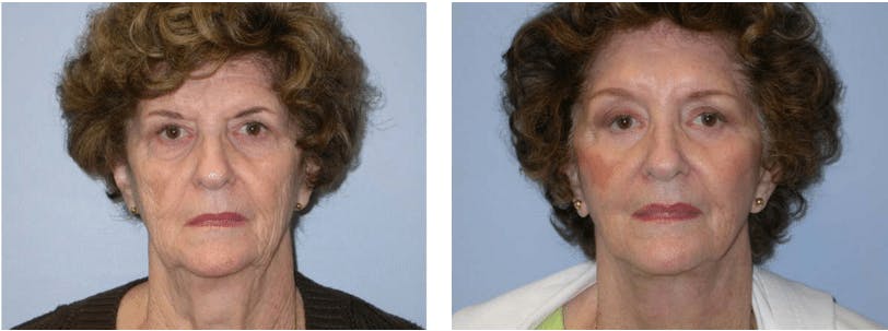 Facelift Before & After Gallery - Patient 74871028 - Image 1