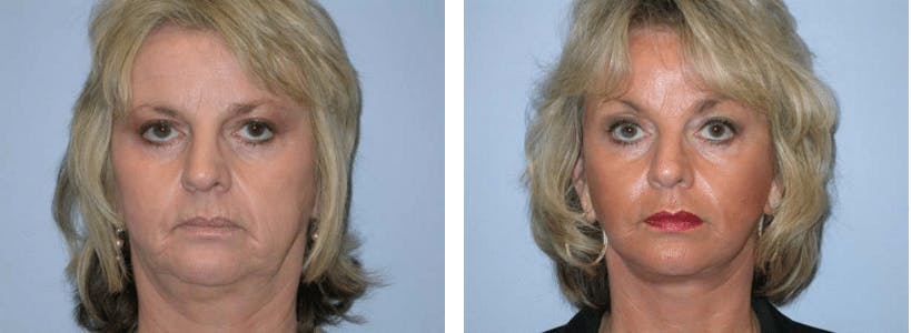 Facelift Before & After Gallery - Patient 74871037 - Image 1