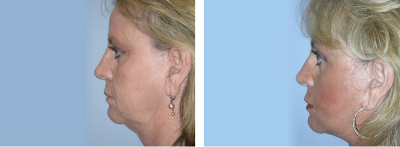 Facelift Before & After Gallery - Patient 74871037 - Image 2