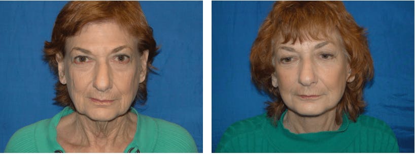 Facelift Before & After Gallery - Patient 74871046 - Image 1