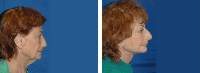 Facelift Before & After Gallery - Patient 74871046 - Image 2