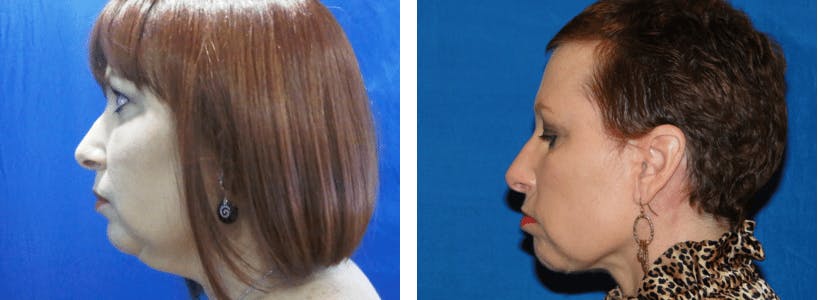 Facelift Before & After Gallery - Patient 74871115 - Image 1