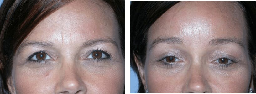 Brow Lift Before & After Gallery - Patient 74871150 - Image 1