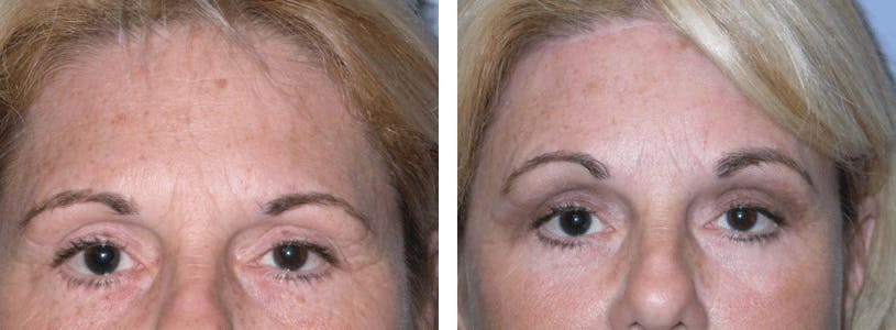Brow Lift Before & After Gallery - Patient 74871167 - Image 1