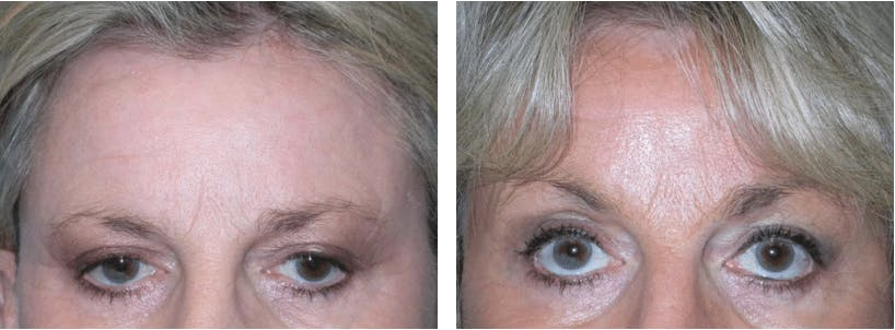 Brow Lift Before & After Gallery - Patient 74871177 - Image 1