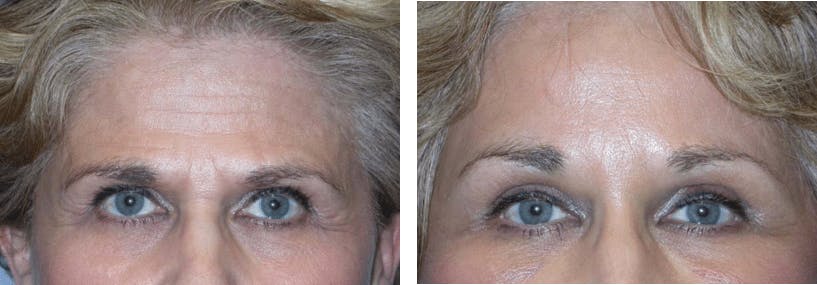 Brow Lift Before & After Gallery - Patient 74871183 - Image 1