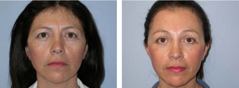 Blepharoplasty Before & After Gallery - Patient 74871246 - Image 1