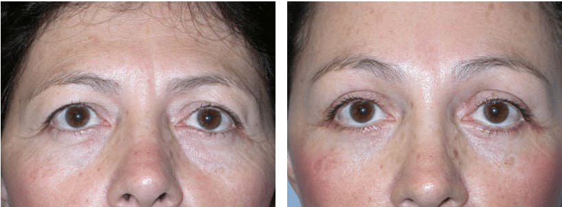 Blepharoplasty