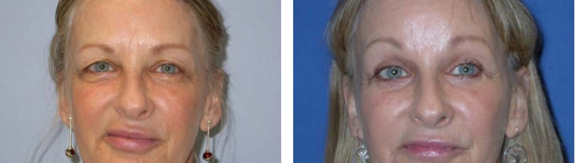 Blepharoplasty Before & After Gallery - Patient 74871247 - Image 1