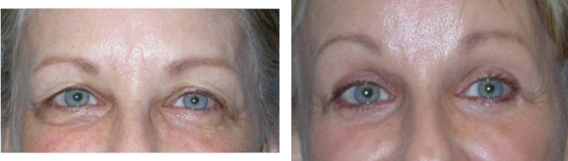 Blepharoplasty Before & After Gallery - Patient 74871247 - Image 2