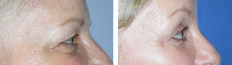 Blepharoplasty Before & After Gallery - Patient 74871247 - Image 3