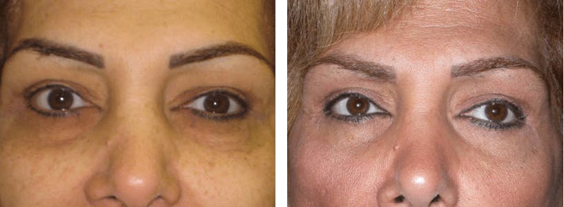 Blepharoplasty Before & After Gallery - Patient 74871239 - Image 1