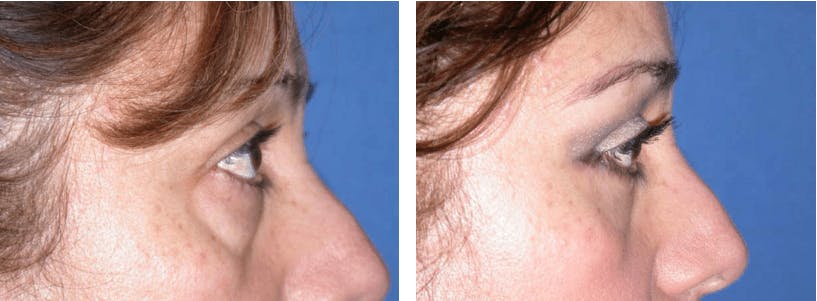 Blepharoplasty Before & After Gallery - Patient 74871254 - Image 1
