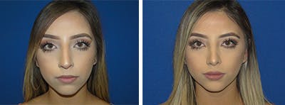 Rhinoplasty Before & After Gallery - Patient 146923814 - Image 1