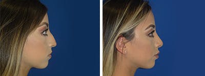 Rhinoplasty Before & After Gallery - Patient 146923814 - Image 2