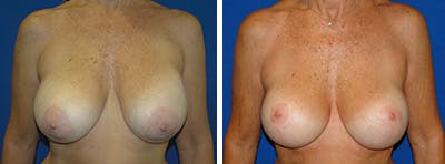 Breast Revision Before & After Gallery - Patient 146923822 - Image 1