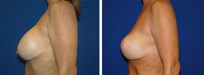 Breast Revision Before & After Gallery - Patient 146923822 - Image 2