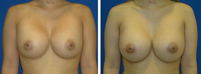 Breast Revision Before & After Gallery - Patient 146923893 - Image 1