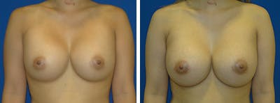 Breast Revision Before & After Gallery - Patient 146923893 - Image 1