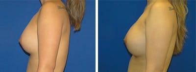 Breast Revision Before & After Gallery - Patient 146923893 - Image 2