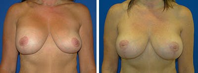 Breast Revision Before & After Gallery - Patient 146923898 - Image 1