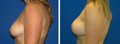 Breast Revision Before & After Gallery - Patient 146923898 - Image 2