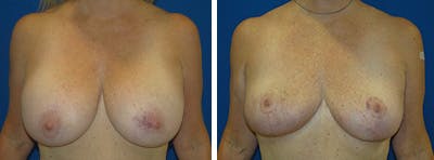 Breast Revision Before & After Gallery - Patient 146923901 - Image 1