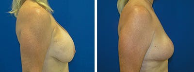 Breast Revision Before & After Gallery - Patient 146923901 - Image 2