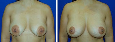 Breast Revision Before & After Gallery - Patient 146923902 - Image 1