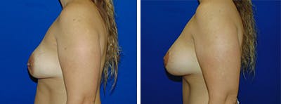 Breast Revision Before & After Gallery - Patient 146923902 - Image 2