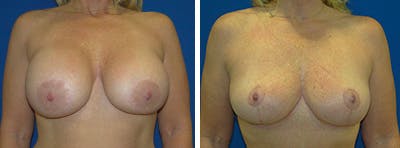 Breast Revision Before & After Gallery - Patient 146923903 - Image 1