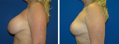 Breast Revision Before & After Gallery - Patient 146923903 - Image 2