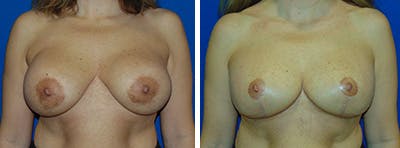 Breast Revision Before & After Gallery - Patient 146923904 - Image 1