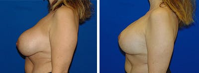 Breast Revision Before & After Gallery - Patient 146923904 - Image 2