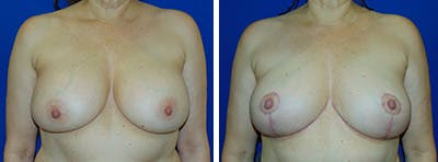 Breast Revision Before & After Gallery - Patient 146923905 - Image 1