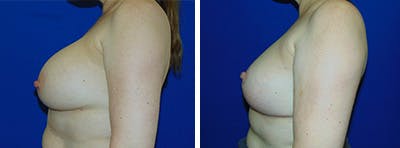 Breast Revision Before & After Gallery - Patient 146923905 - Image 2