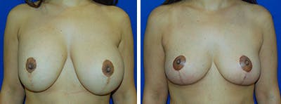 Breast Revision Before & After Gallery - Patient 146923908 - Image 1