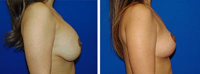 Breast Revision Before & After Gallery - Patient 146923908 - Image 2