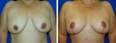 Breast Reduction Before & After Gallery - Patient 146924081 - Image 1