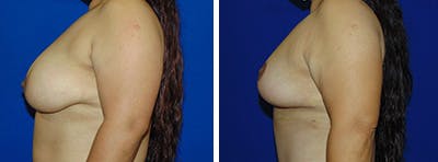 Breast Reduction Before & After Gallery - Patient 146924081 - Image 2